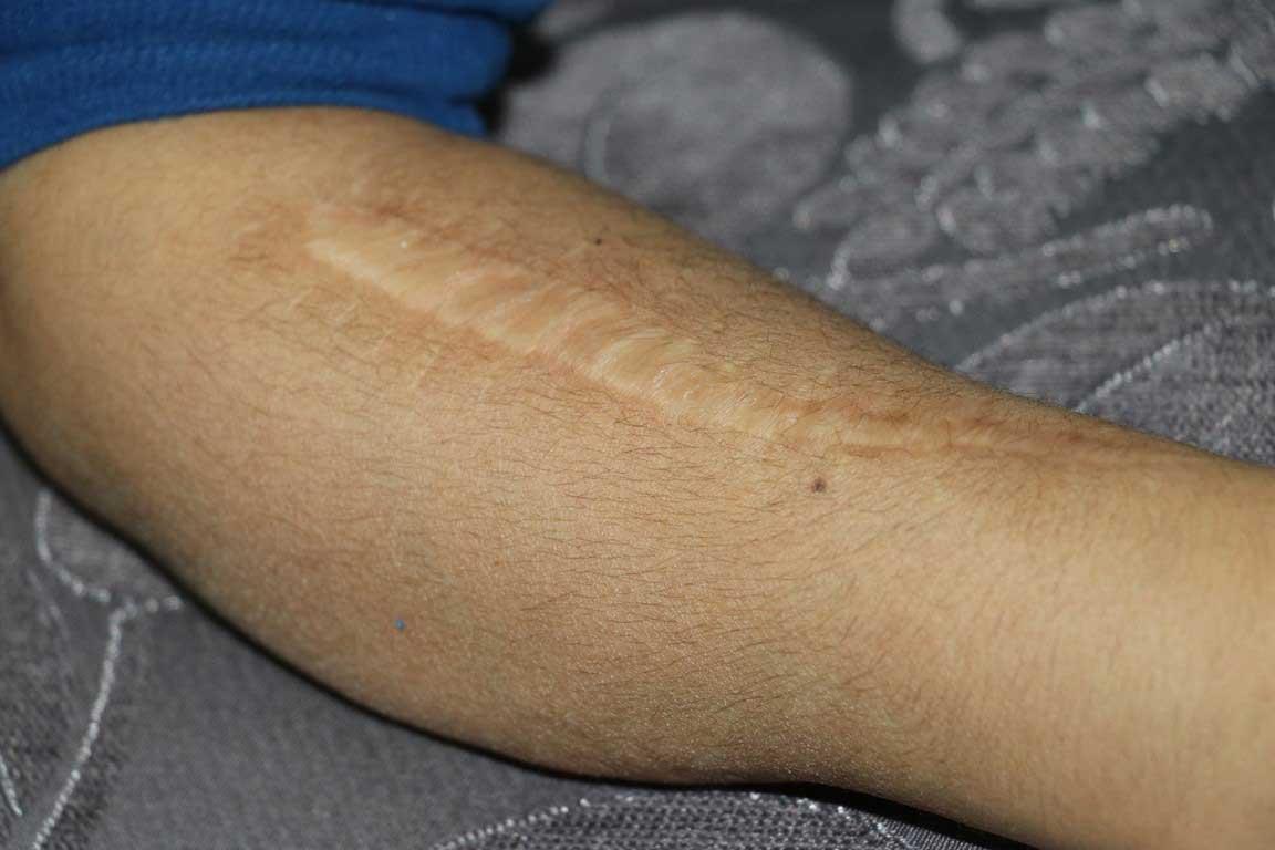 Doğumda kızlarının kolu sakat kalan ailenin 11 yıllık hukuk mücadelesi sürüyor